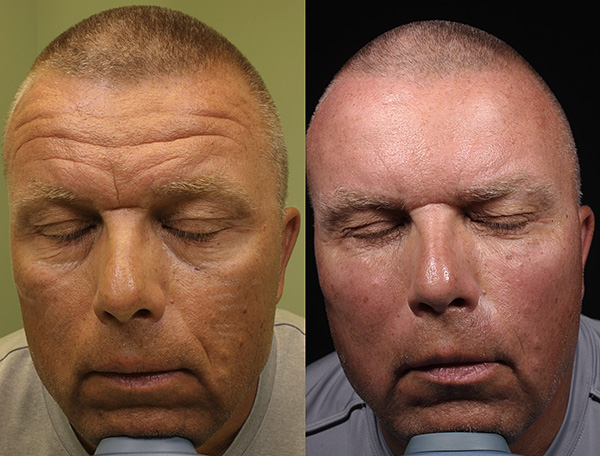 L'action de la toxine botulique entraîne la relaxation musculaire, ce qui aplanit les rides.