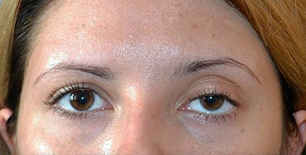 Dans certains cas, il y a une conséquence indésirable telle que l'omission de la paupière.