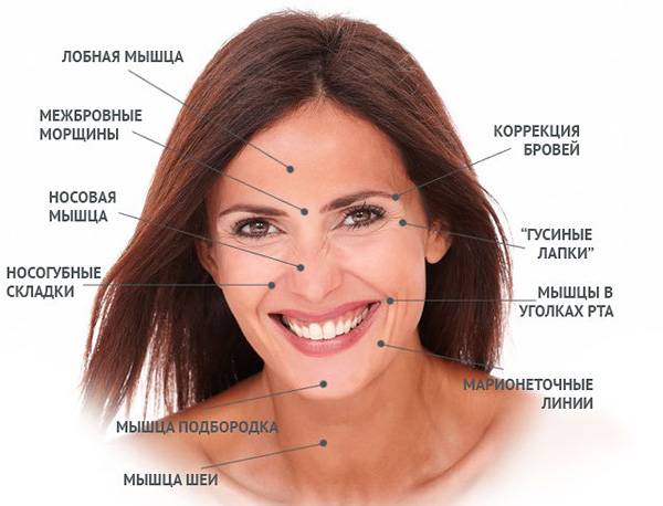 Zones de correction du Botox