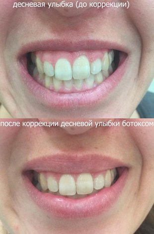 Gomme sourire correction