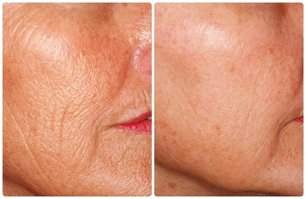 L'effet de l'application en surface de la toxine botulique