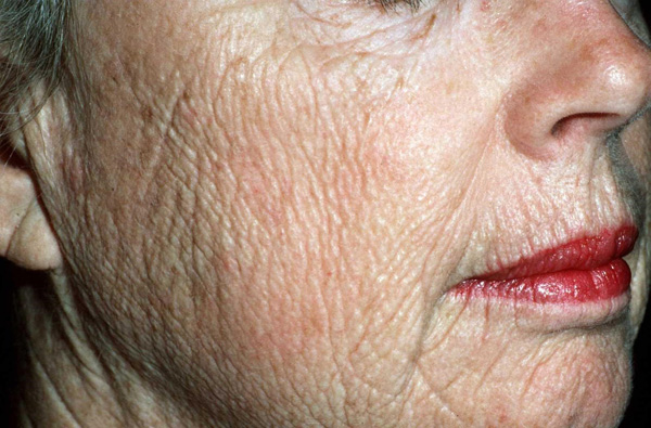 Amincissement de la peau lié à l'âge