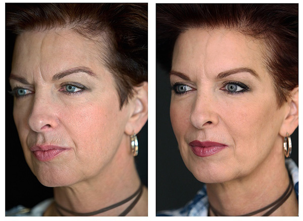 Correction des rides glabellaires (entre crochets) avec Botox.
