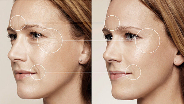 Correction des rides du visage