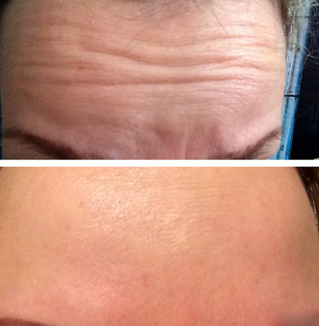 Application Relatox (avant et après)