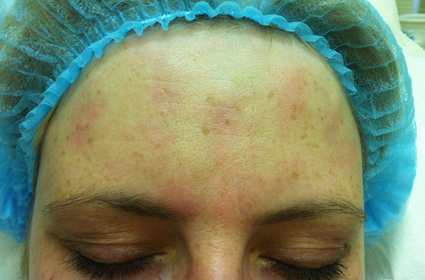 Sites d'injection après Botulax