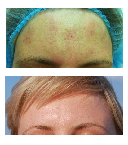 Lissage des rides du front en une semaine