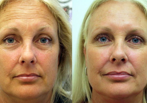 Photographie du patient avant et après Botulax