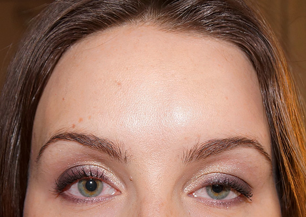 Ptosis après injection de Botox