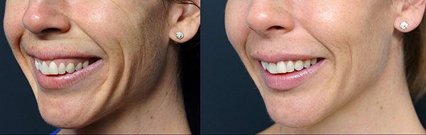 Condition des rides avant et après la procédure.