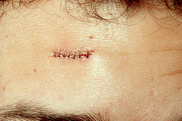 Le stade intermédiaire du traitement.