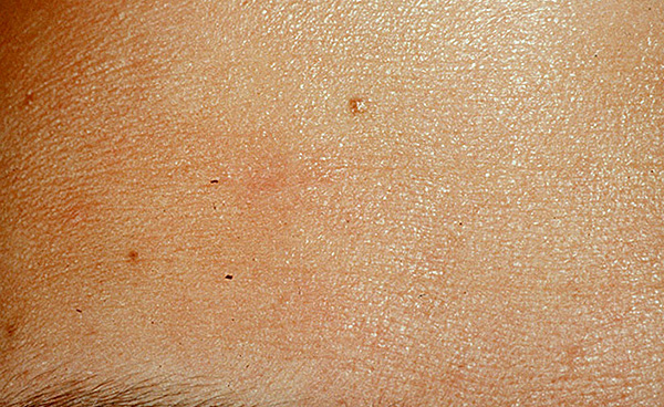 Résultat de correction de cicatrice.