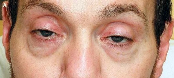 Déficience visuelle