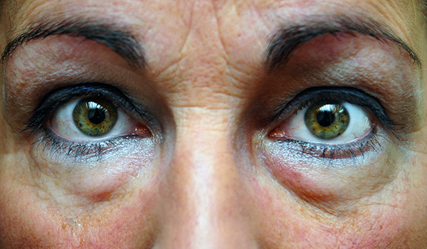 Botox pour la hernie oculaire