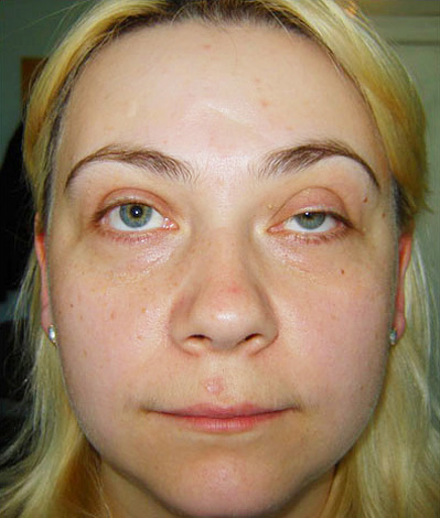 Nous examinons les raisons pour lesquelles les paupières baissent parfois après un traitement au botulinum, ainsi que les moyens d'éliminer le défaut ... Nous examinons les raisons pour lesquelles les paupières baissent parfois après un traitement au botulinum, ainsi que les moyens d'éliminer le défaut ...