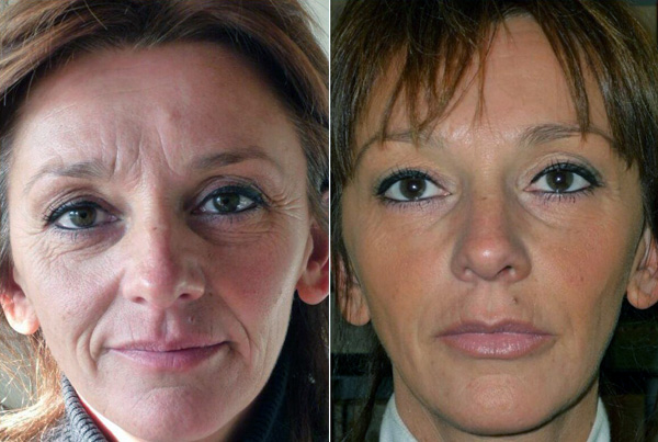 Élimination complexe des rides sur la peau âgée