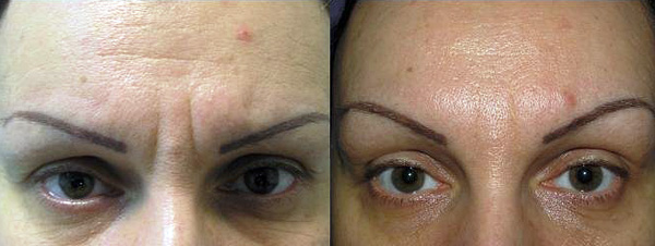 Botox réparation des rides