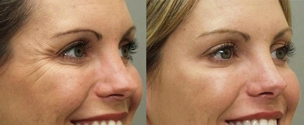 Dysport est également efficace pour éliminer les soi-disant 