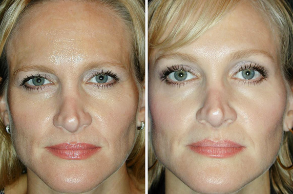 Avec Botox, vous pouvez lever la paupière et rendre vos yeux plus ouverts.