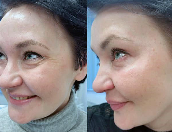 Correction des rides du visage dans les coins des yeux avec Botox (avant et après)