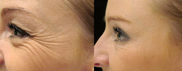 Élimination des rides dans le coin des yeux et dans la partie supérieure des joues (avant et après l'introduction du Botox)