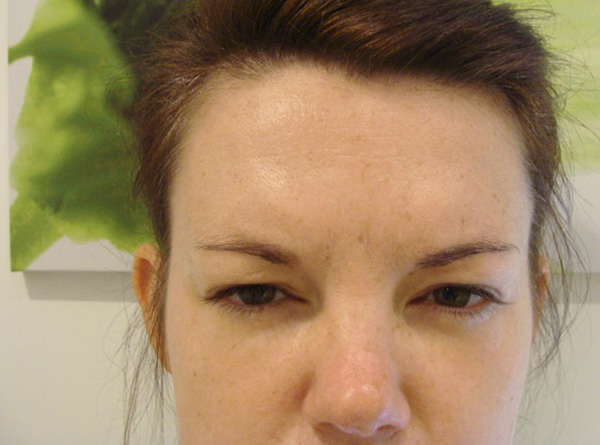 L'effet d'un visage diabolique après l'application de Botox