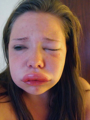 Œdème de Quincke après injection, procédures cosmétiques