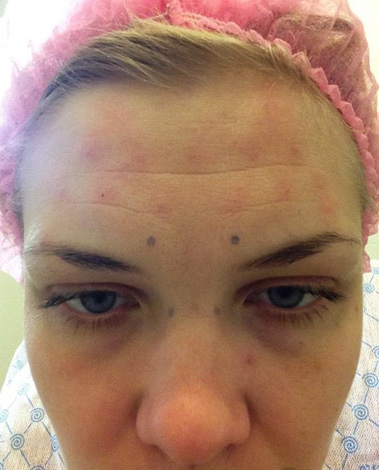 Rougeur et gonflement au site d'injection de Botox