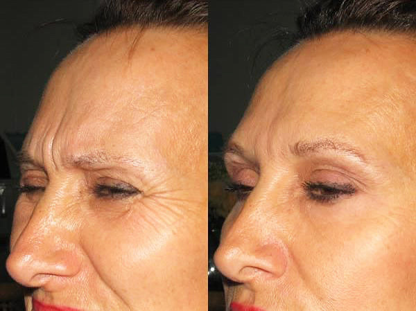 La formation du rouleau superciliaire à la suite des injections de Botox