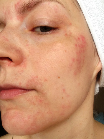 Une réaction allergique au Botox