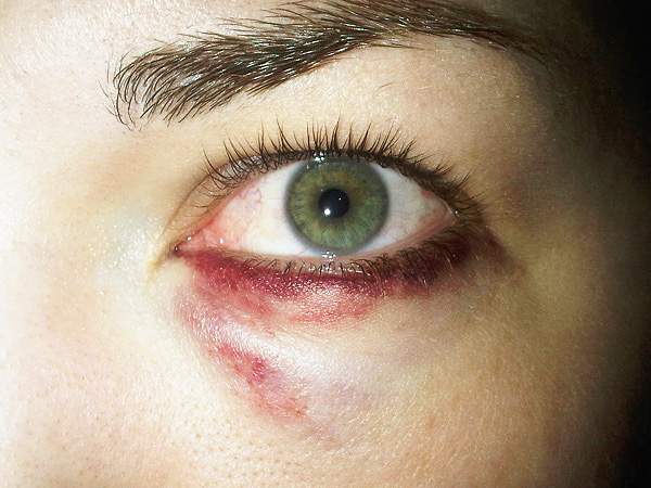 Oedème au site d'injection de toxine botulique