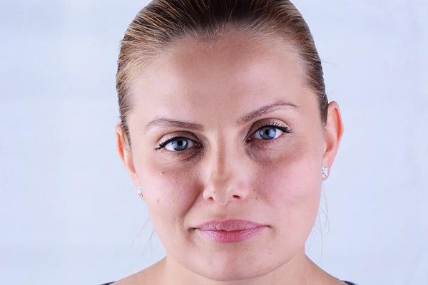 Asymétrie du visage à la suite d'un traitement botulinique