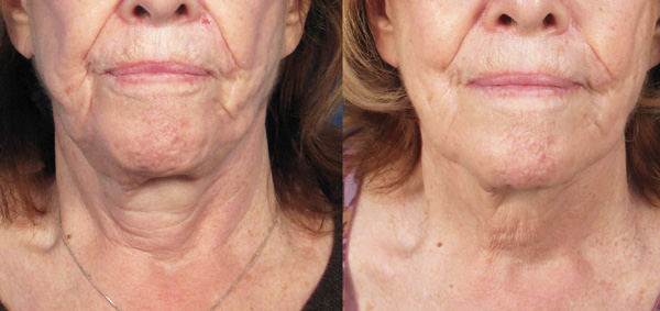 Augmentation de l'élasticité de la peau avec des préparations de toxine botulique