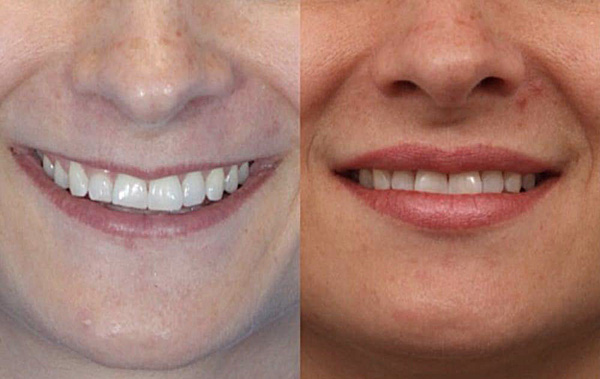 Le retour du volume naturel des lèvres dû à l'affaiblissement des muscles de la lèvre supérieure par Botox