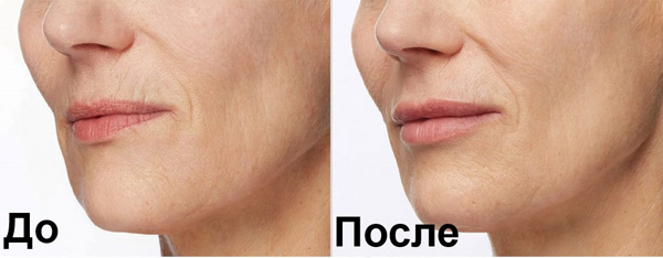 Éliminer les rides autour des lèvres et leur donner du volume avec des charges