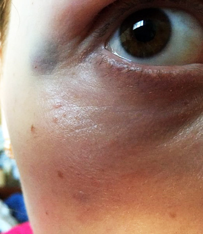 Des ecchymoses et un gonflement se forment souvent sur les sites d’administration de Relatox