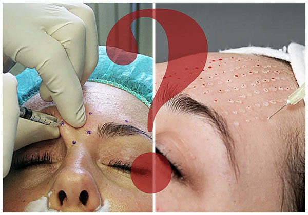 Nous découvrons quelle est la différence entre le Botox et la bio-revitalisation et quelle procédure est préférable de privilégier une situation donnée ... Nous découvrons quelle est la différence entre le Botox et la bio-revitalisation et quelle procédure est préférable de privilégier une situation donnée ...