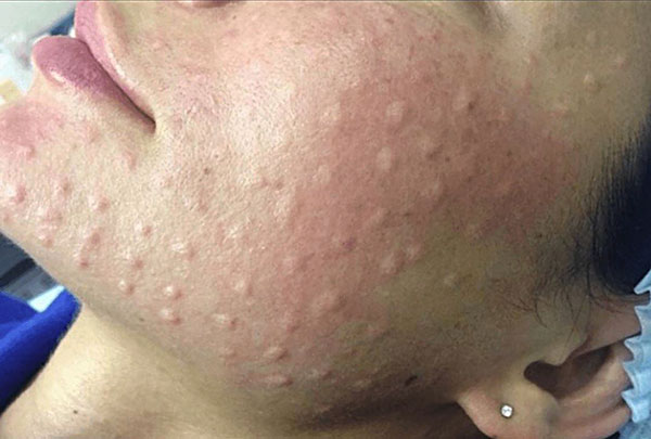 Administration d'acide haluronique