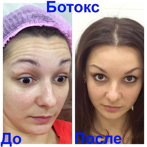 Élimination des rides dynamiques du front avec Botox (avant et après la procédure)