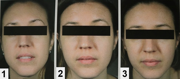 Botox Correction du contour du visage