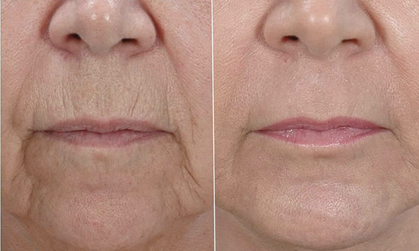 Les lignes de marionnettes sont difficiles à éliminer complètement que le Botox