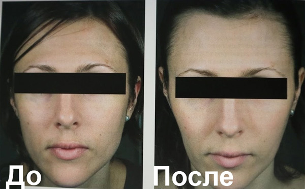 Allongement et rétrécissement excessifs du visage après le Botox