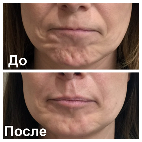 Botox anti-rides sur le menton