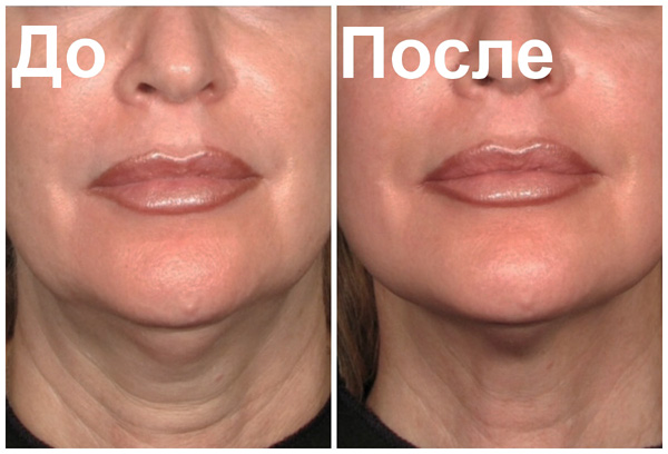 Lissage des rides à la toxine botulique