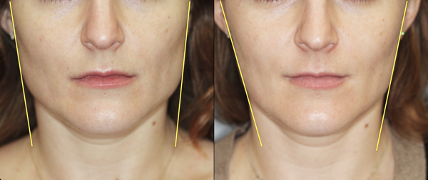 Botulinum rétrécissant avec la thérapie botulinique