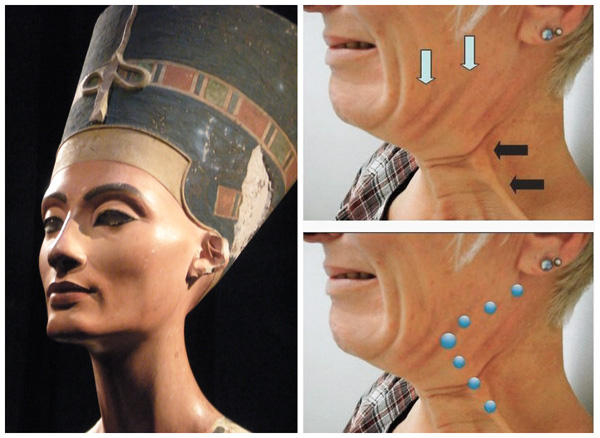 Levage Nefertiti, sites d'injection