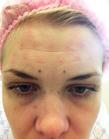 Des traces après le Botox