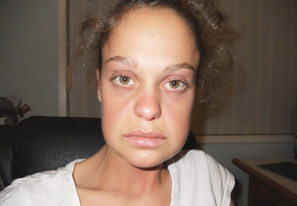 Gonflement du visage après l'introduction de charges