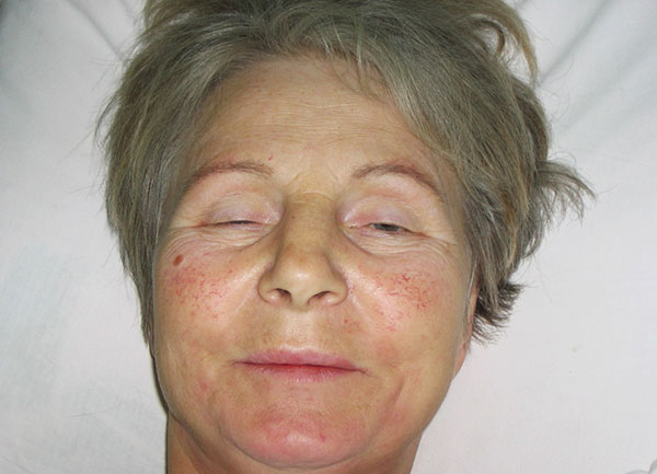 Intoxication par la toxine botulique