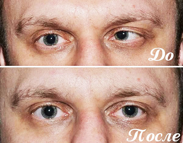 Correction du strabisme au Botox